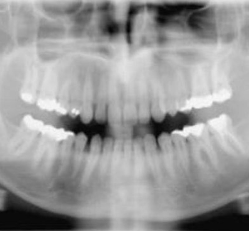 Example output x-ray from the orthoralix 8500